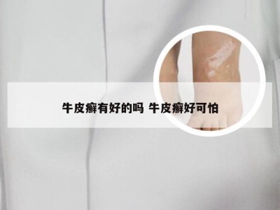 牛皮癣有好的吗 牛皮癣好可怕