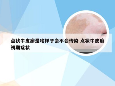 点状牛皮癣是啥样子会不会传染 点状牛皮癣初期症状