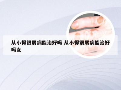 从小得银屑病能治好吗 从小得银屑病能治好吗女
