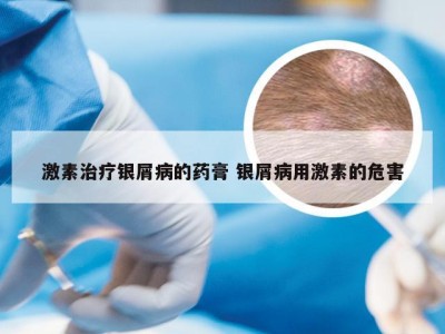 激素治疗银屑病的药膏 银屑病用激素的危害