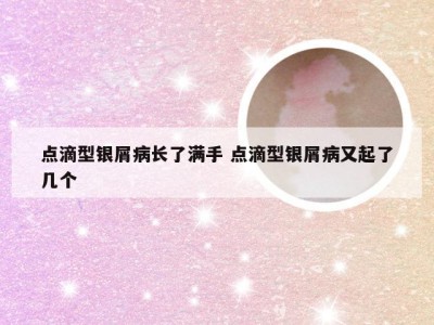 点滴型银屑病长了满手 点滴型银屑病又起了几个