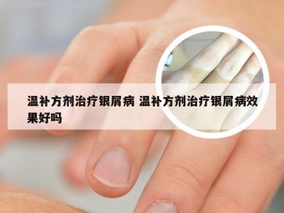 温补方剂治疗银屑病 温补方剂治疗银屑病效果好吗