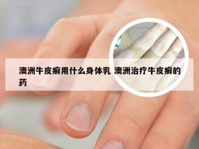 澳洲牛皮癣用什么身体乳 澳洲治疗牛皮癣的药