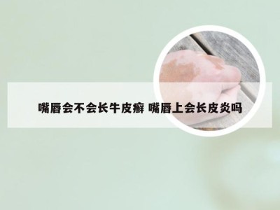 嘴唇会不会长牛皮癣 嘴唇上会长皮炎吗