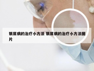 银屑病的治疗小方法 银屑病的治疗小方法图片
