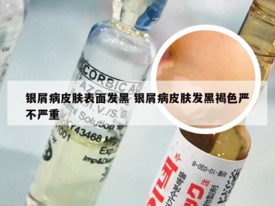 银屑病皮肤表面发黑 银屑病皮肤发黑褐色严不严重