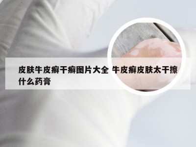 皮肤牛皮癣干癣图片大全 牛皮癣皮肤太干擦什么药膏