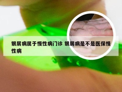 银屑病属于慢性病门诊 银屑病是不是医保慢性病