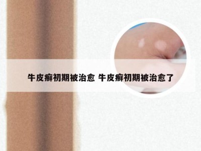 牛皮癣初期被治愈 牛皮癣初期被治愈了