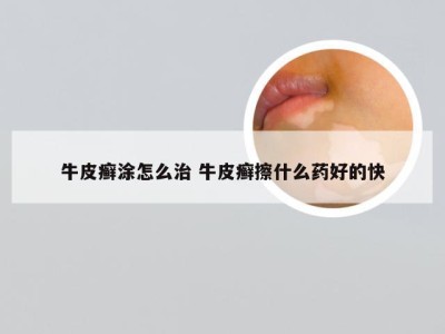 牛皮癣涂怎么治 牛皮癣擦什么药好的快