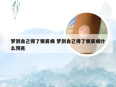 梦到自己得了银屑病 梦到自己得了银屑病什么预兆