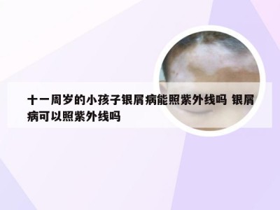 十一周岁的小孩子银屑病能照紫外线吗 银屑病可以照紫外线吗
