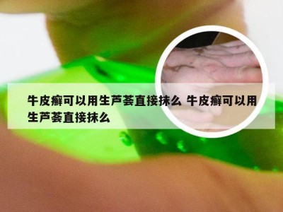 牛皮癣可以用生芦荟直接抹么 牛皮癣可以用生芦荟直接抹么