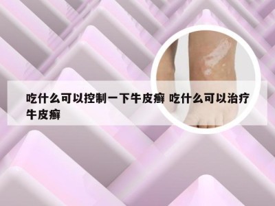 吃什么可以控制一下牛皮癣 吃什么可以治疗牛皮癣