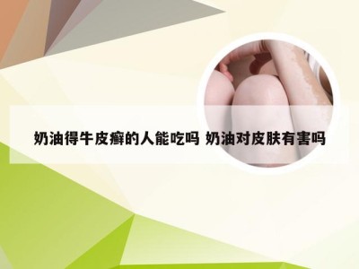 奶油得牛皮癣的人能吃吗 奶油对皮肤有害吗