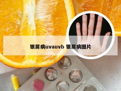 银屑病uvauvb 银屑病图片
