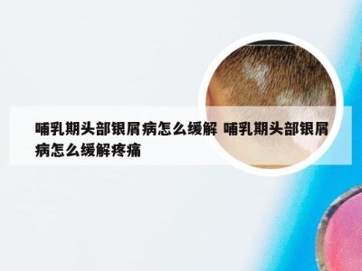 哺乳期头部银屑病怎么缓解 哺乳期头部银屑病怎么缓解疼痛