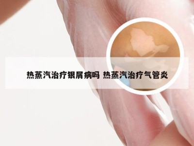 热蒸汽治疗银屑病吗 热蒸汽治疗气管炎