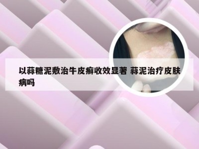 以蒜糖泥敷治牛皮癣收效显著 蒜泥治疗皮肤病吗