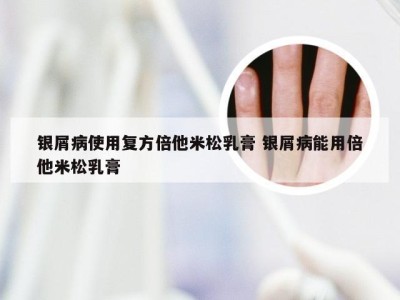 银屑病使用复方倍他米松乳膏 银屑病能用倍他米松乳膏