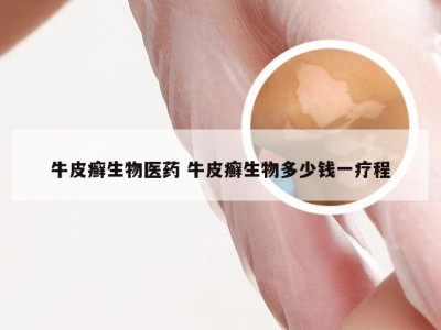牛皮癣生物医药 牛皮癣生物多少钱一疗程