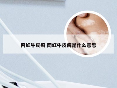 网红牛皮癣 网红牛皮癣是什么意思