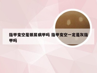 指甲变空是银屑病甲吗 指甲变空一定是灰指甲吗