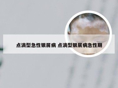 点滴型急性银屑病 点滴型银屑病急性期