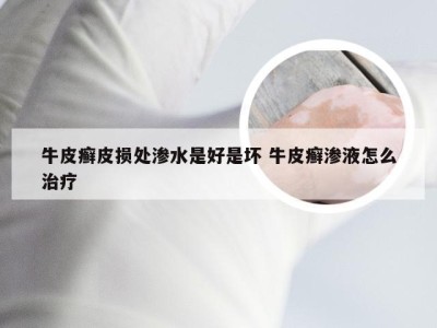 牛皮癣皮损处渗水是好是坏 牛皮癣渗液怎么治疗