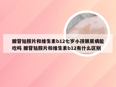 腺苷钴胺片和维生素b12七岁小孩银屑病能吃吗 腺苷钴胺片和维生素b12有什么区别