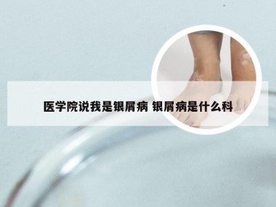 医学院说我是银屑病 银屑病是什么科