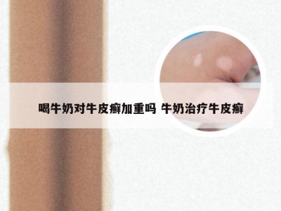 喝牛奶对牛皮癣加重吗 牛奶治疗牛皮癣