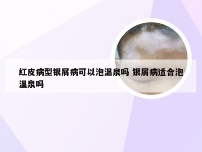 红皮病型银屑病可以泡温泉吗 银屑病适合泡温泉吗