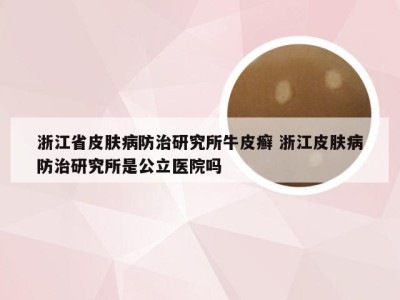 浙江省皮肤病防治研究所牛皮癣 浙江皮肤病防治研究所是公立医院吗