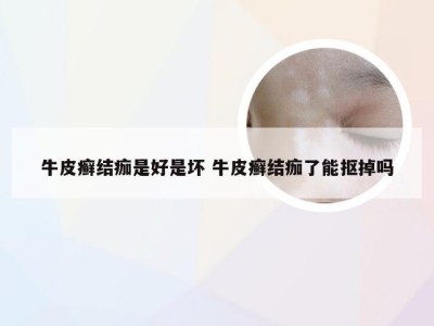 牛皮癣结痂是好是坏 牛皮癣结痂了能抠掉吗