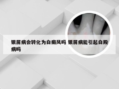 银屑病会转化为白癜风吗 银屑病能引起白殿病吗