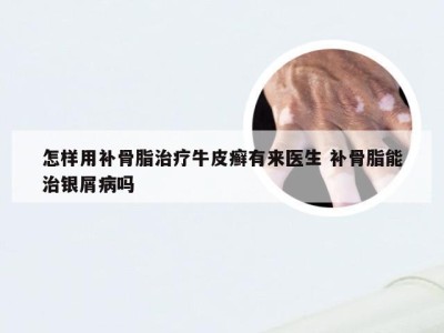 怎样用补骨脂治疗牛皮癣有来医生 补骨脂能治银屑病吗