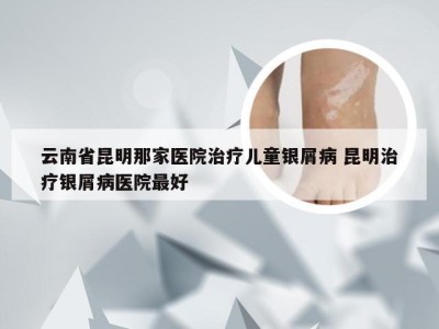 云南省昆明那家医院治疗儿童银屑病 昆明治疗银屑病医院最好