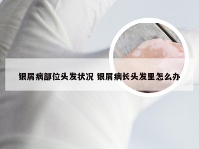 银屑病部位头发状况 银屑病长头发里怎么办