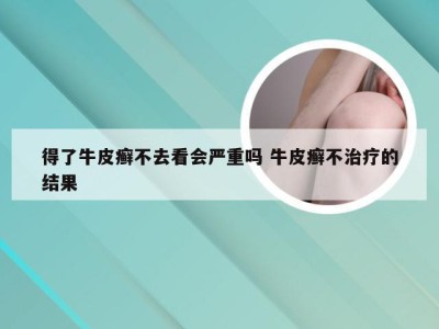 得了牛皮癣不去看会严重吗 牛皮癣不治疗的结果