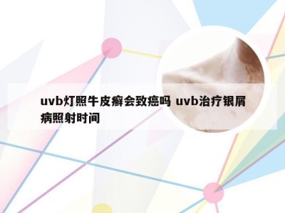 uvb灯照牛皮癣会致癌吗 uvb治疗银屑病照射时间