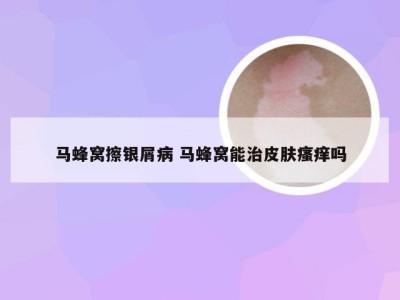马蜂窝擦银屑病 马蜂窝能治皮肤瘙痒吗