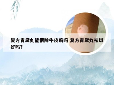复方青黛丸能根除牛皮癣吗 复方青黛丸祛斑好吗?