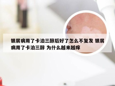 银屑病用了卡泊三醇后好了怎么不复发 银屑病用了卡泊三醇 为什么越来越痒