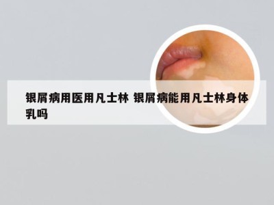 银屑病用医用凡士林 银屑病能用凡士林身体乳吗