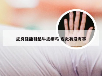 皮炎轻能引起牛皮癣吗 皮炎有没有事