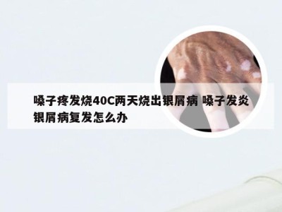 嗓子疼发烧40C两天烧出银屑病 嗓子发炎银屑病复发怎么办