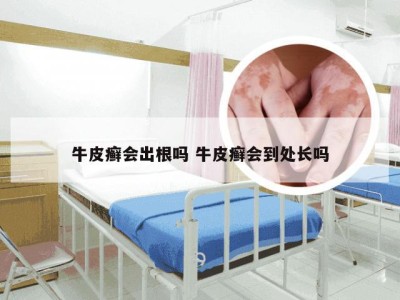 牛皮癣会出根吗 牛皮癣会到处长吗
