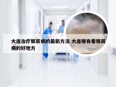 大连治疗银屑病的最新方法 大连哪有看银屑病的好地方