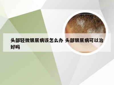 头部轻微银屑病该怎么办 头部银屑病可以治好吗